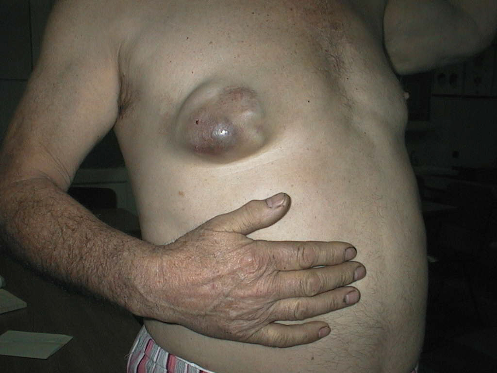cancer mamelon barbati
